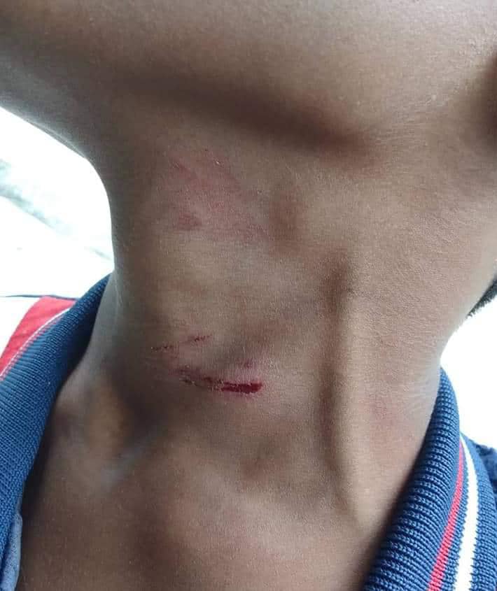 Pelajar dakwa dirotan guru hingga cedera kerana tidak siap kerja sekolah 1 rotan